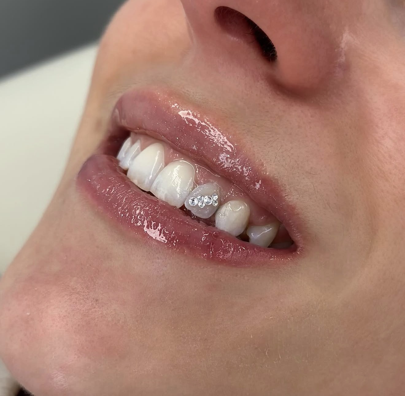Toothgems