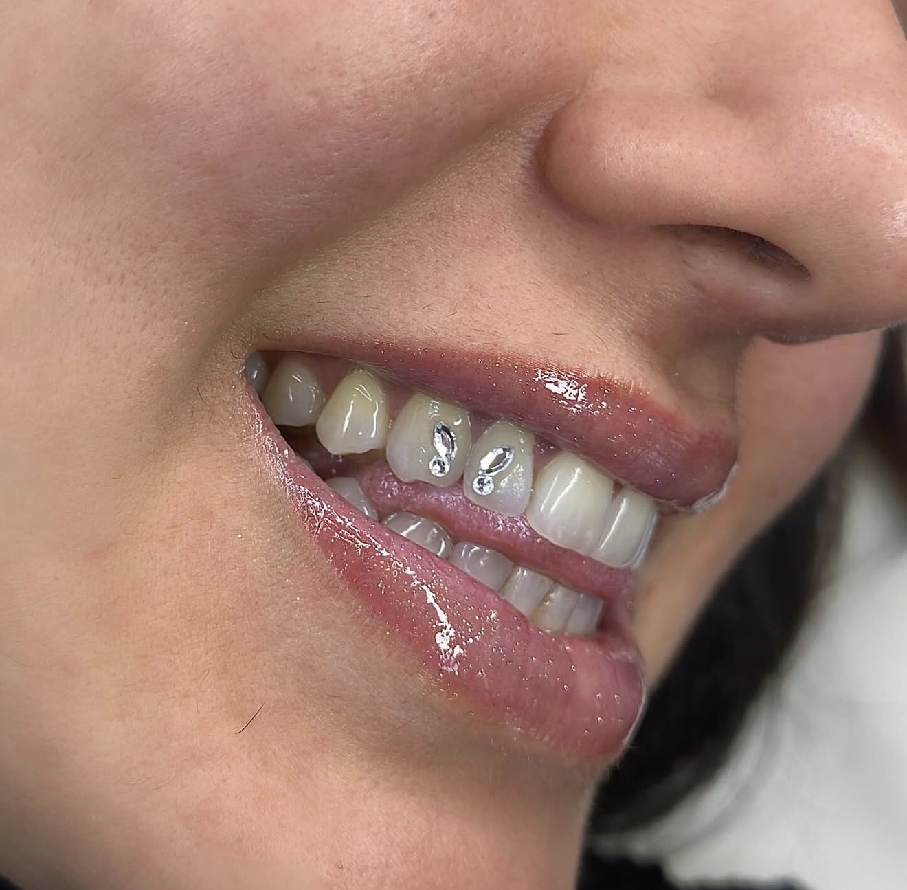 Toothgems resultaat 1