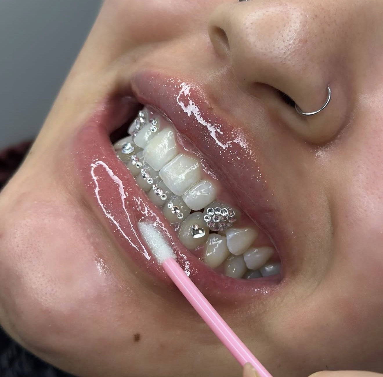 Toothgems resultaat 2