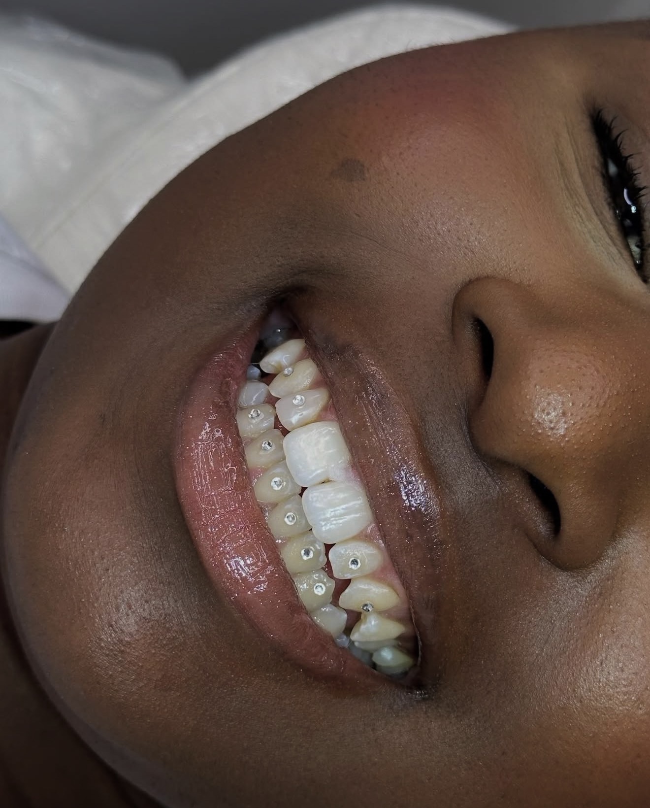 Toothgems resultaat 3